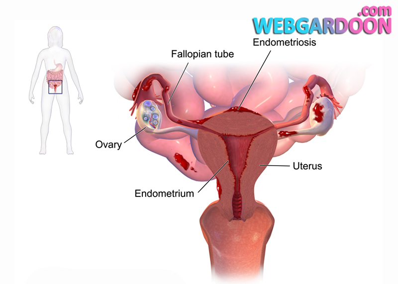 علائم سرطان تخمدان,عوامل خارش، سوزش و تحریک واژن