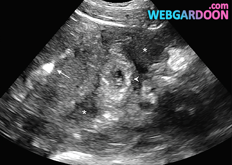حاملگی خارج رحمی (Ectopic pregnancy)