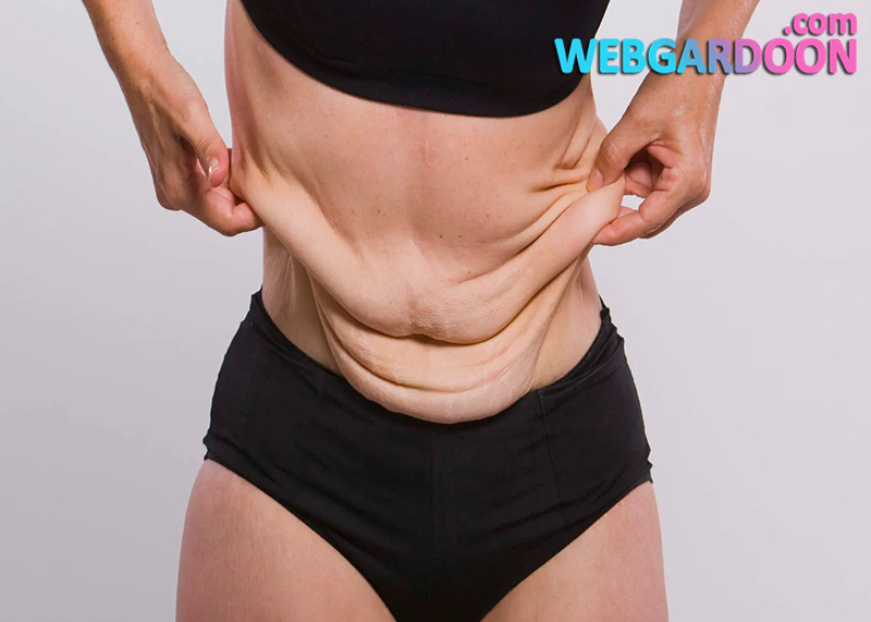 سفت کردن پوست شل پس از کاهش وزن,وبگردون,مجله اینترنتی وبگردون,webgardoon